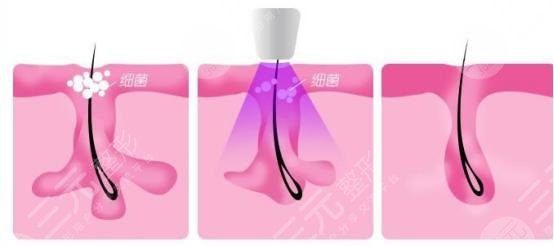 彩光嫩肤去痘价格贵吗？轻医美脉冲光“照亮”你的美！