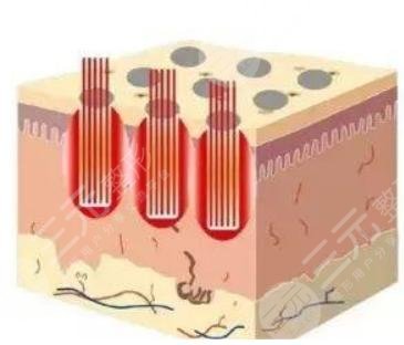 什么是激光缓解痘疤