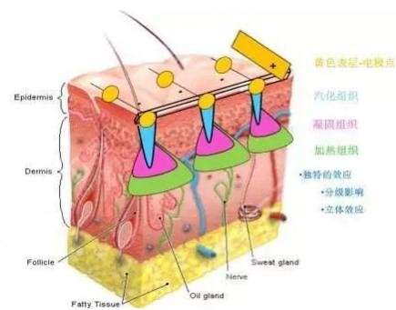 激光缓解痘疤的原理