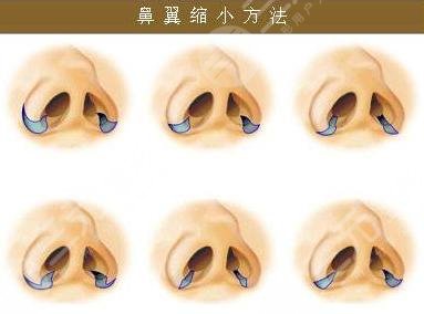 鼻翼缩小手术应遵循什么原则