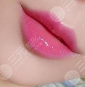 玻尿酸丰唇术成好吗？5大注意事项|玻尿酸丰唇术后案例果