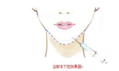 玻尿酸丰下巴是什么