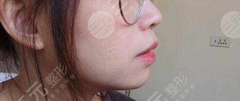 注射玻尿酸丰下巴3大术后注意事项