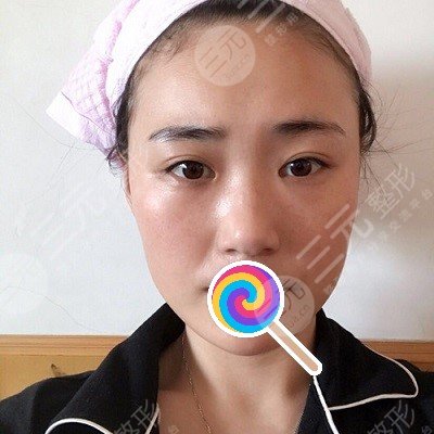 九院韦敏综合鼻案例