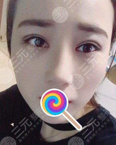 九院韦敏综合鼻案例