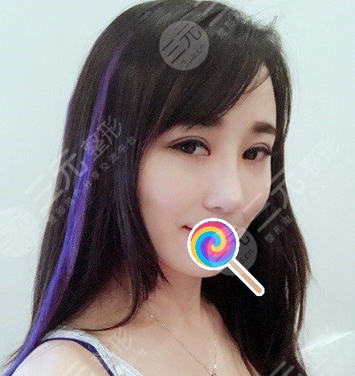 九院韦敏综合鼻案例