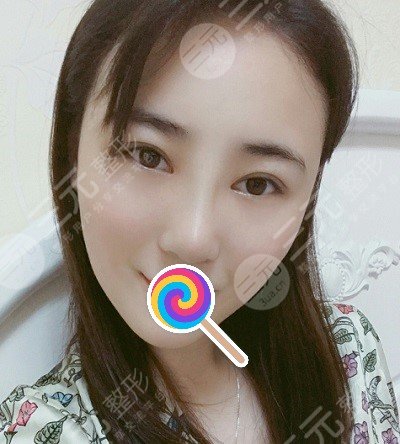 九院韦敏综合鼻案例