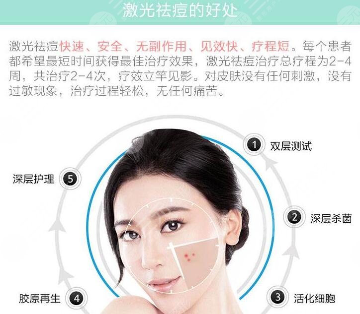 激光祛痘