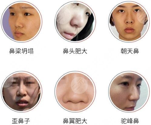 假体隆鼻手术注意事项