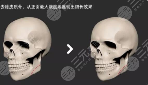 骨质增生