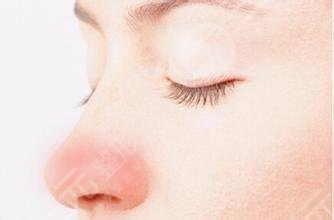 酒糟鼻整形术价格