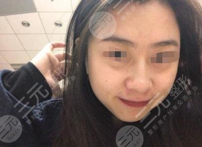 上海九院热玛吉过程分享