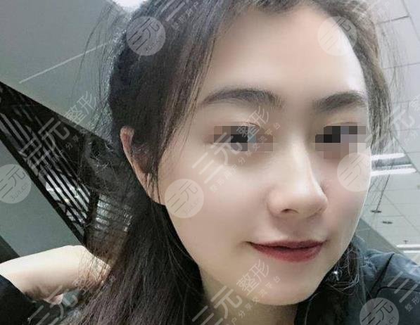 上海九院热玛吉过程分享