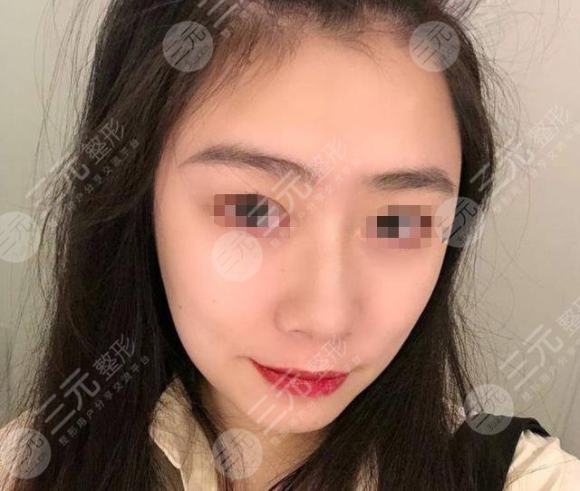 上海九院热玛吉过程分享