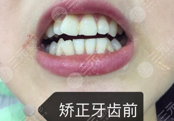 武汉德亚口腔牙齿矫正分享