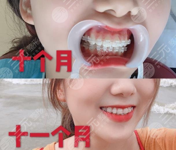 武汉德亚口腔牙齿矫正分享