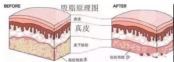 肚子脂肪怎么抽抽脂瘦腹部手术超全科普教你消灭小肚腩