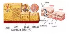 肚子脂肪怎么抽？抽脂瘦腹部手术超全科普，教你“消灭”小肚腩！