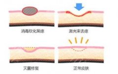 像素激光除痘印有吗？优点&价格科普！