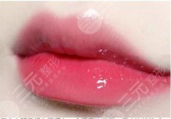 胶原蛋白丰唇好吗，会肿胀吗？科普4大问题，get果冻美唇！