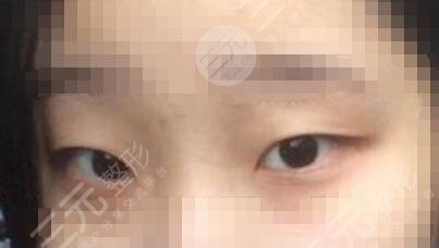 上海久雅王金伟双眼皮前