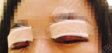 上海久雅王金伟双眼皮后2天