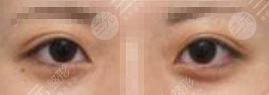 上海久雅王金伟双眼皮后52天