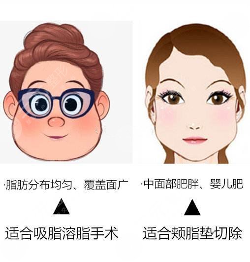 去颊脂垫恢复时间