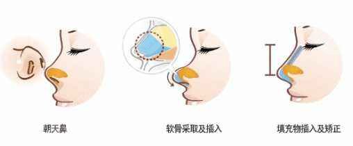 朝天鼻纠正手术