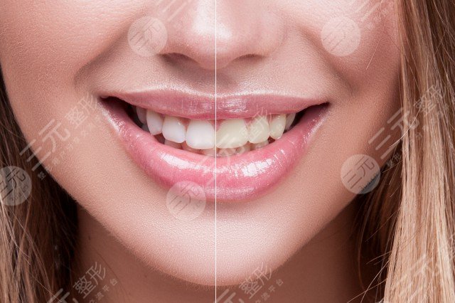 胶原蛋白丰唇价格是多少