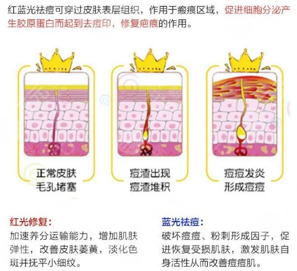 蓝光祛痘多少钱一次？让“医美光”照亮你的美！