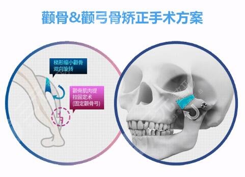 改脸型需要多少钱?
