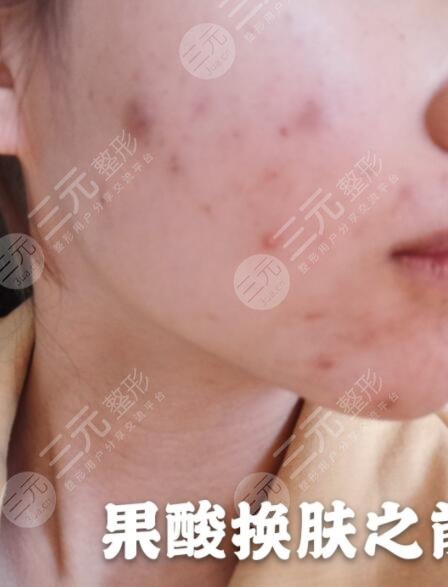 果酸换肤案例前