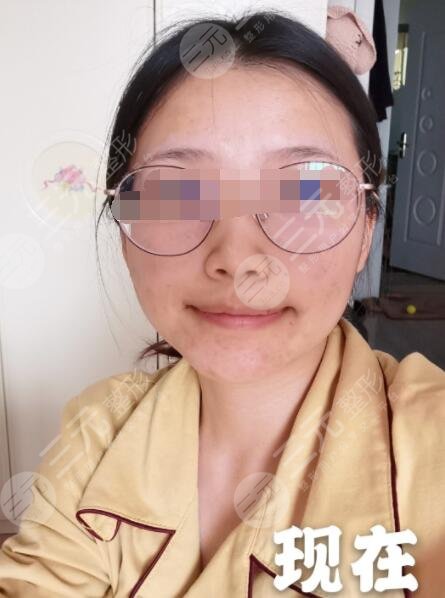 果酸换肤案例后