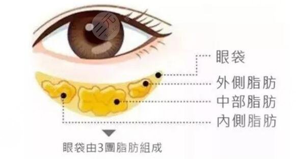 眼袋手术的术后护理