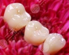 美容冠多少钱一颗？修复你的牙，闪亮笑容就靠ta！