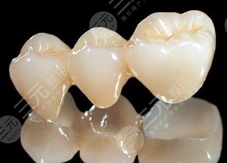 美容冠多少钱一颗修复你的牙闪亮笑容就靠ta