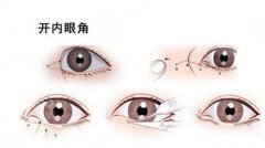 开内眼角多久恢复好？手术风险&术后护理宝典分享，必备功课！