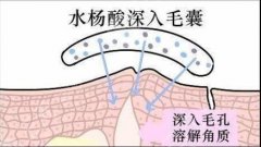 水杨酸祛痘有用吗？原理科普，原来ta也可以果酸换肤！