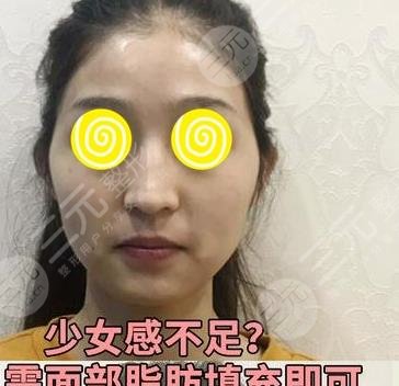 武汉协和郭亮脂肪面部填充前