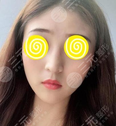 武汉协和郭亮脂肪面部填充后1个月