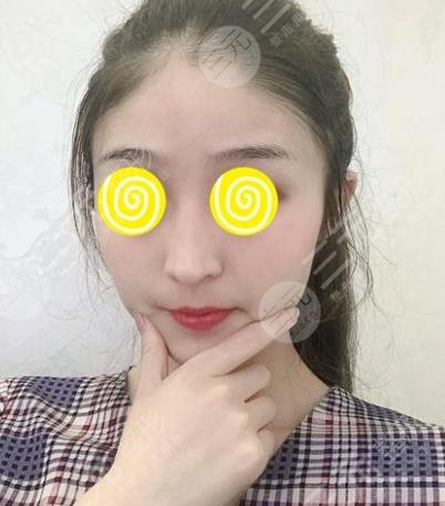 武汉协和郭亮脂肪面部填充后4个月