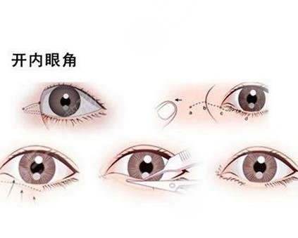 不适合开眼角眼型