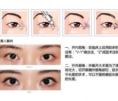 开眼角手术适合哪些人？