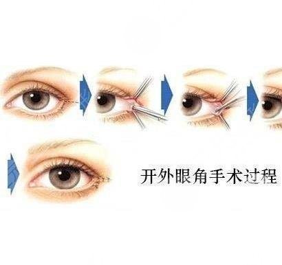 开眼角手术后