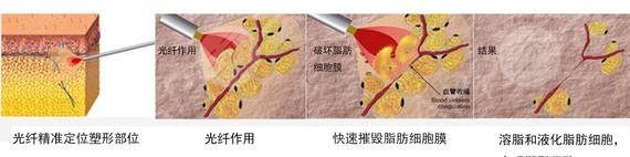 激光溶脂瘦腿原理&优点讲解！夏天show美腿，你还犹豫啥？