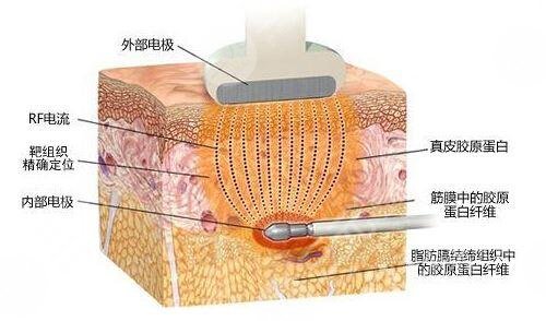 激光溶脂瘦腿