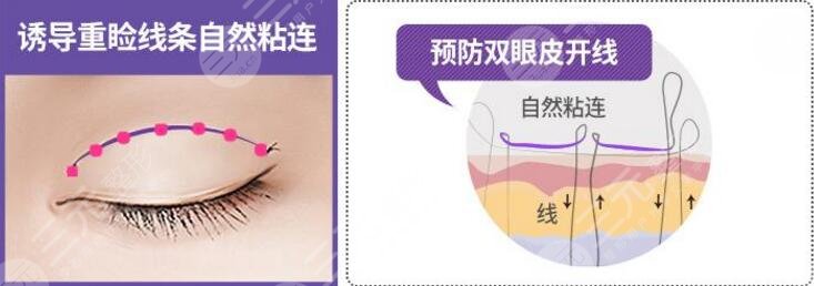 眼睛埋线多少钱