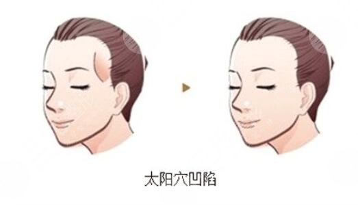 脂肪填充太阳穴的优势