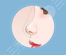 自体软骨移植隆鼻术